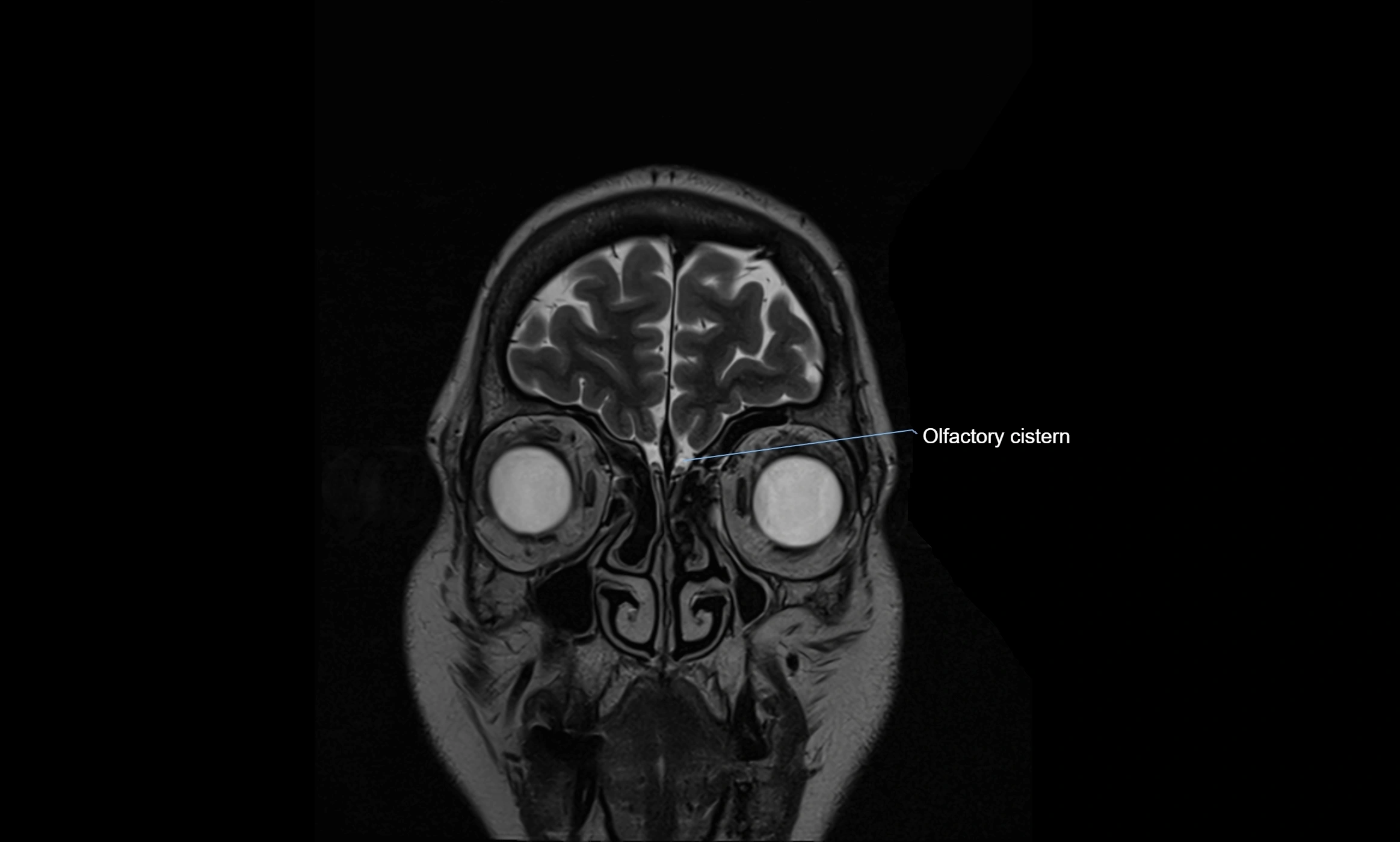 Brain cisterns  and ventricles coronal anatomy 3T MRI image-img-00001-00002.webp